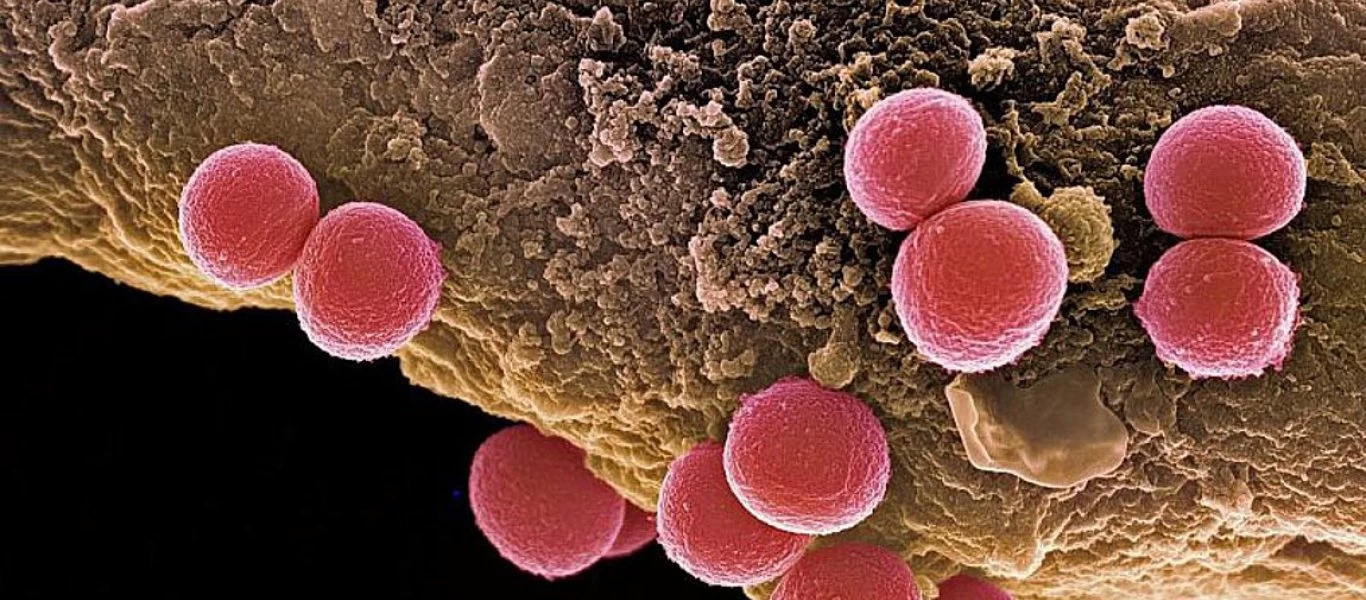 Λοίμωξη από σταφυλόκοκκο – Πώς θα την αναγνωρίσετε